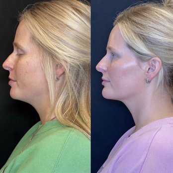 Just Wellness - Nefertiti neck left - Cryotherapy Near Me - Grapevine, Texas Just Wellness - Nefertiti neck left - Cryotherapy Near Me - Grapevine, Texas