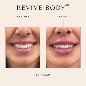 revive semaglutide reviews Revive Body MD - Updated May 2026 - 121 Photos & 62 Reviews - 636 E Santa  Clara St, San Jose, California - Weight Loss Centers Experts - Phone Number