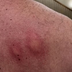 Comfort Inn & Suites Ponca City Near Marland Mansion - Bug bites