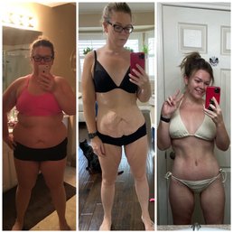 After significant weight loss Dr. Pancholi helped remove excess skin around my entire body. After significant weight loss Dr. Pancholi helped remove excess skin around my entire body.