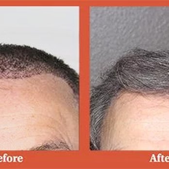 Irwin B Simon, MD - Dr. Simon of Vegas Valley Hair Restoration - Before and After photo - Doctors Near Me - Henderson, Nevada Irwin B Simon, MD - Dr. Simon of Vegas Valley Hair Restoration - Before and After photo - Doctors Near Me - Henderson, Nevada