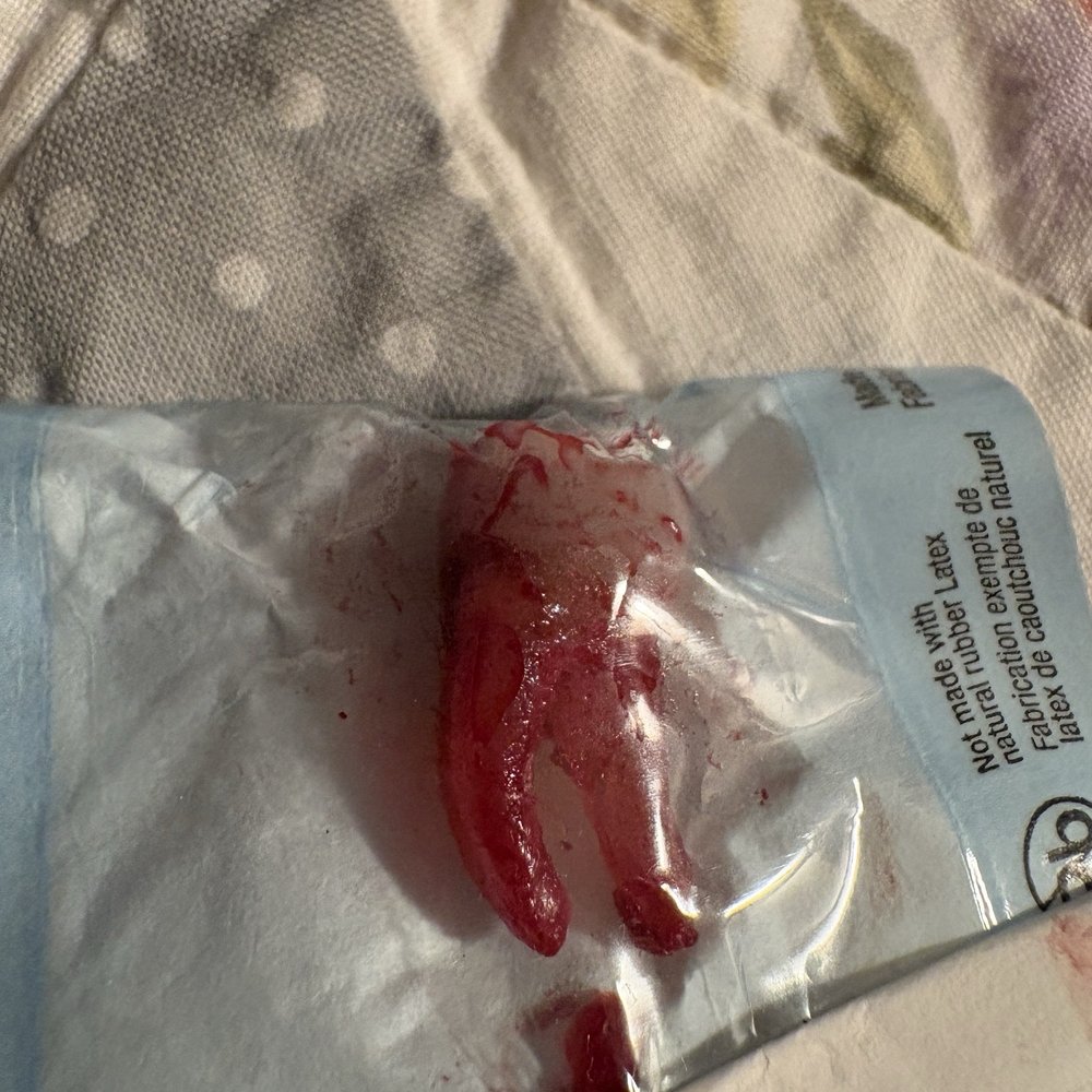 Tooth after being extracted today 9 mnths after they did the job by a more honest dentist Tooth after being extracted today 9 mnths after they did the job by a more honest dentist