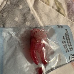 Tooth after being extracted today 9 mnths after they did the job by a more honest dentist Tooth after being extracted today 9 mnths after they did the job by a more honest dentist