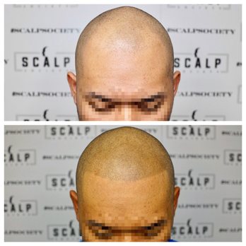 Scalp Society - Before / After - Hair Loss Centers Near Me - San Francisco, California Scalp Society - Before / After - Hair Loss Centers Near Me - San Francisco, California