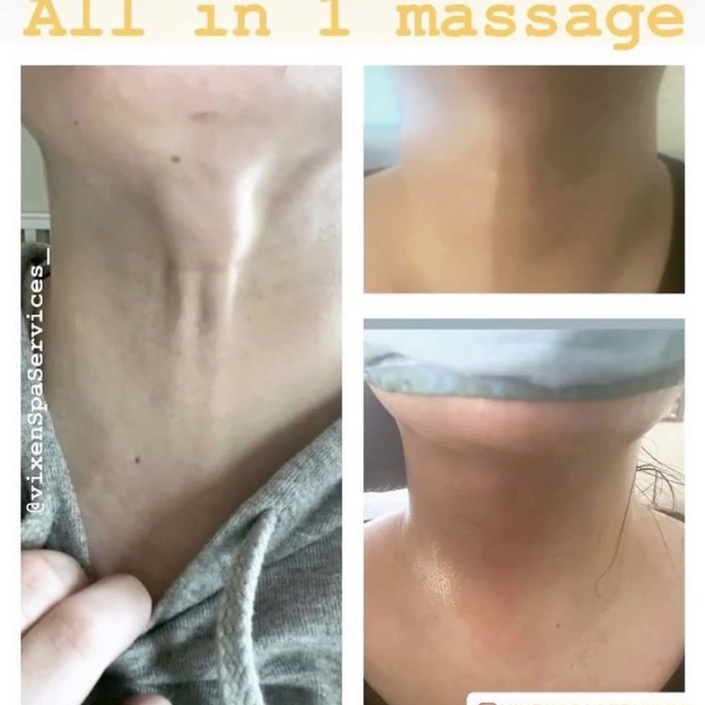 Chin Lipo! Got rid of scar tissue and lump I had all in one session Chin Lipo! Got rid of scar tissue and lump I had all in one session