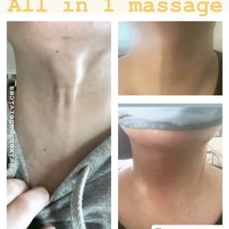 Chin Lipo! Got rid of scar tissue and lump I had all in one session Chin Lipo! Got rid of scar tissue and lump I had all in one session