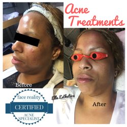 Elle Esthetics - See improvement after one treatment. More treatments may be needed to achieve the desired result.