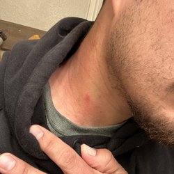Velocity Paintball Park - Rash from rental gear.