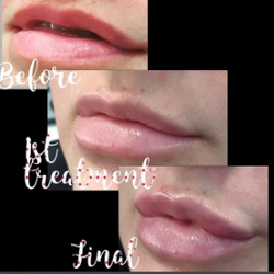 The Skin Spot MedSpa - #tranform#valentines#lips#pump#enhance#aesthetics#dermalfillers#beautyindustryprofessionals