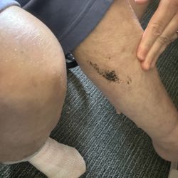 Green Ridge Care Center - This bruise is called an eschar it needs to be debrided