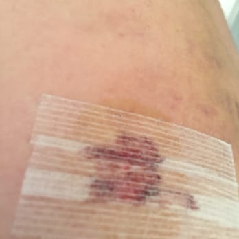 Michael P Muldoon, MD - Suture torn by staff, then infected- not fun! - Sports Medicine Near Me - San Diego, California Michael P Muldoon, MD - Suture torn by staff, then infected- not fun! - Sports Medicine Near Me - San Diego, California