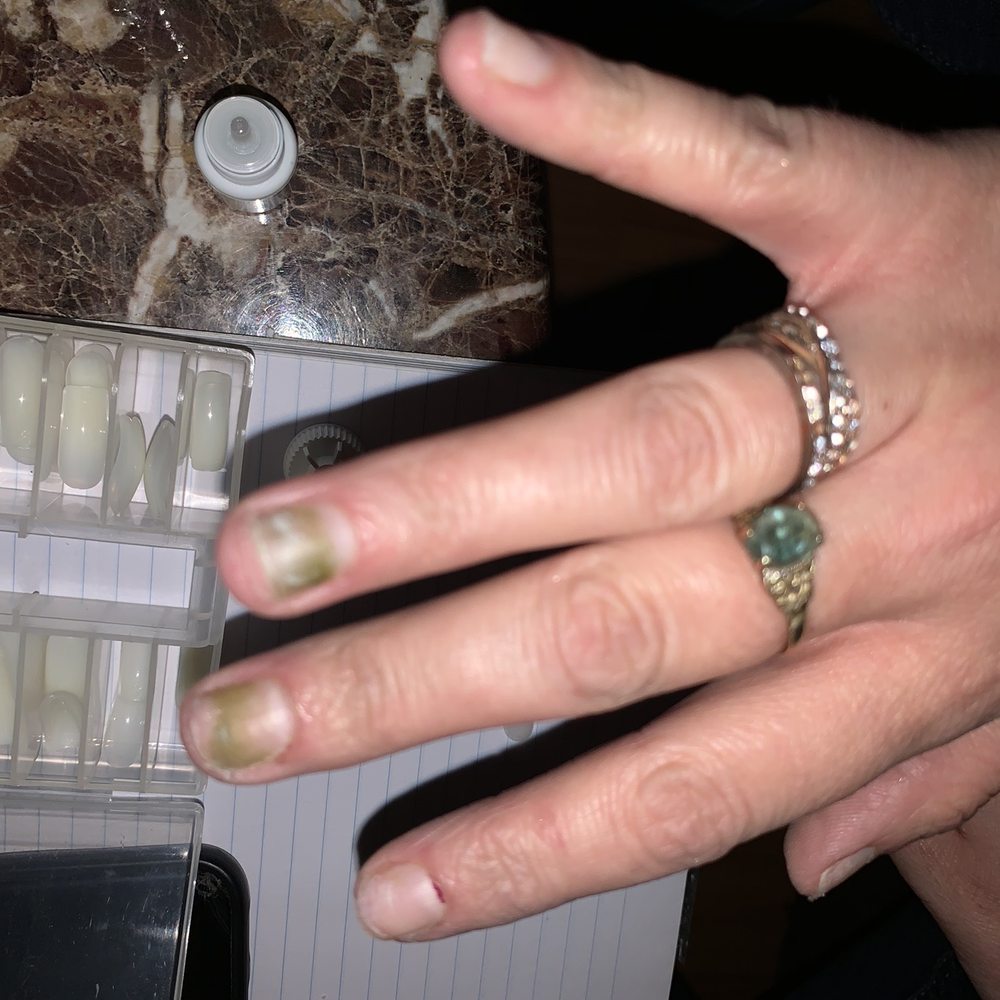 Fungal Infection... Fungal Infection...