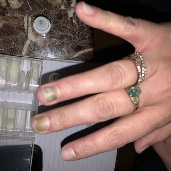 Massena Nails Spa - Fungal Infection... - Nail Salons Near Me - Massena, New York Massena Nails Spa - Fungal Infection... - Nail Salons Near Me - Massena, New York