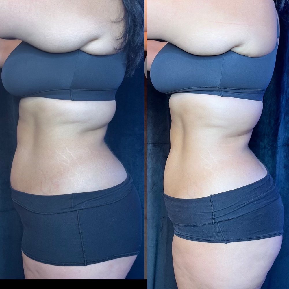 Shapetress - Before and after - Body Contouring Near Me - North Hollywood, California Shapetress - Before and after - Body Contouring Near Me - North Hollywood, California