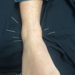Madrid Acupuncture