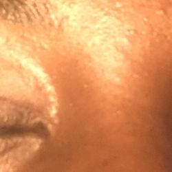 Perfect Brows NYC - First degree burn on eye