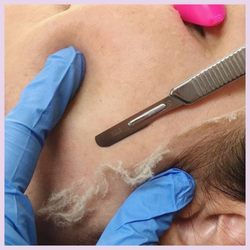 Skin Rehab - Dermaplaning