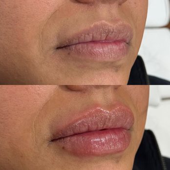 Glam MediSpa - Lip Augmentation - Medical Spas Near Me - Van Nuys, California