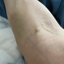 Labcorp - Like bruising?