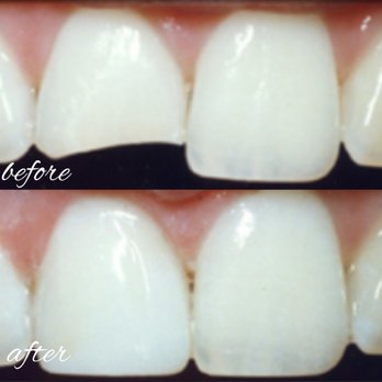 Creative Dimensions in Dentistry - Dental Bonding - Cosmetic Dentists Near Me - Castro Valley, California