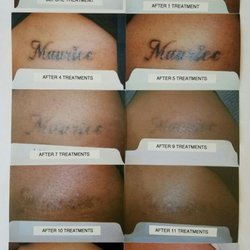 Smooth - Slight hypo-pigmentation of dark skin after removal.