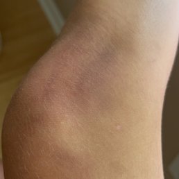 bruise from falling off the tube