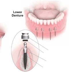 Armani Dentures - 4 Mini implants implanted in the jaw bone to stabilize permanent removable dentures for total of as low as $3500.