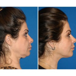 Afterglow Physician Directed Medical Aesthetics - Ultherapy (non-surgical facelift) using ultrasound technology to effectively lift and tighten skin