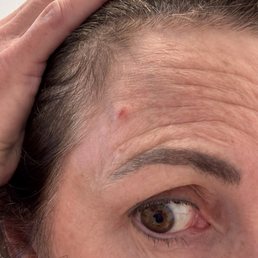 2-days post dermaplane