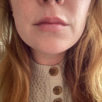 Alchemy 43 - West 3rd - 10 days later! no posing and no gloss. love my lips! - Skin Care Near Me - Los Angeles, California