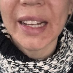 The Aesthetics Lounge and Spa - Crooked laugh was much worse