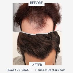 The Hair Loss Doctors By Robert J. Dorin - Male Before / After Sample from The Hair Loss Doctors By Robert J. Dorin with Surgical Headquarters in Garden City, NY.