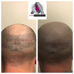 Hair transplant scar correction and scalp micro pigmentation before and after.