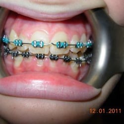 Gentle Dentistry - About 5 months into treament