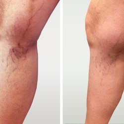 Boston Vein Care - Spider vein before and after sclerotherapy 2