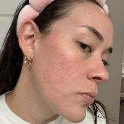 Irritated skin barrier - June 2026