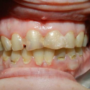 Gentle Dentistry - Start-patient is very scare of dentist - General Dentistry Near Me - Modesto, California