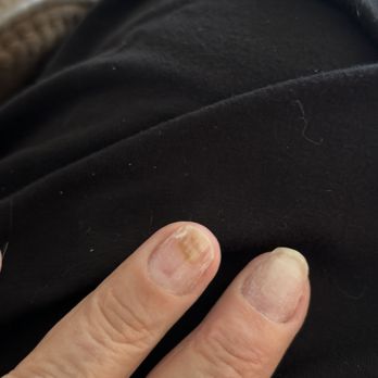 Elsa' Nail Spa & Lashes - One fungal nail on this hand. - Nail Salons Near Me - Bakersfield, California Elsa' Nail Spa & Lashes - One fungal nail on this hand. - Nail Salons Near Me - Bakersfield, California