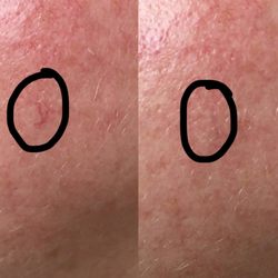 Blossom Med Spa - Laser Vein removal