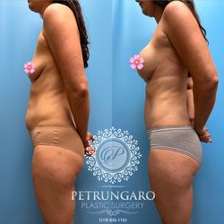 Petrungaro Plastic Surgery - Mommy Makeover -- breast lift with implants, tummy tuck, belly button hernia repair, liposuction of the abdomen, waist, and flanks.