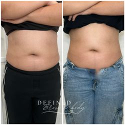 Cryo Therapy is very effective for the stubborn fat . See results right away and is non-invasive