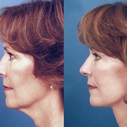 Facial Plastic Surgery Center - Revision Rhinoplasty