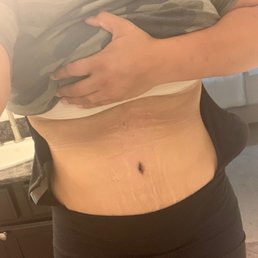 18 days post op!
