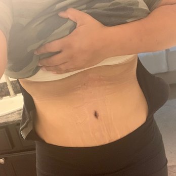 Athenix - 18 days post op! - Medical Spas Near Me - Irvine, California
