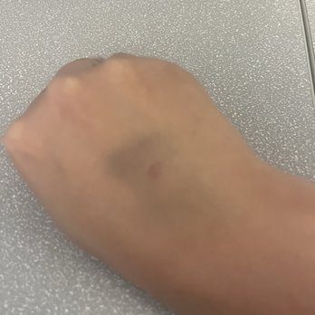 Labcorp - Bruises from blood draw - Laboratory Testing Near Me - Arlington, Virginia Labcorp - Bruises from blood draw - Laboratory Testing Near Me - Arlington, Virginia