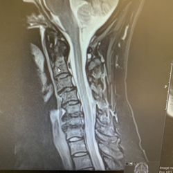 Vero Orthopaedics - "Normal MRI - there's no reason you should be in pain, maybe we need to raise your blood pressure." Actual advice from Vero Orthopedics.