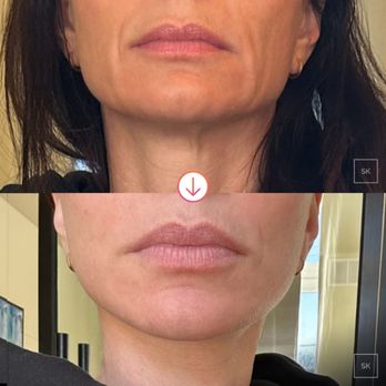 SK Plastic Surgery - Before after deep plane face and neck lift. - Cosmetic Surgeons Near Me - Beverly Hills, California SK Plastic Surgery - Before after deep plane face and neck lift. - Cosmetic Surgeons Near Me - Beverly Hills, California