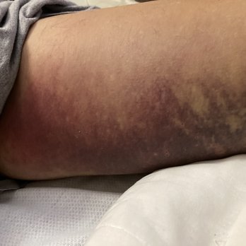 Autumn Leaves - More bruising. - Hospice Near Me - Dallas, Texas