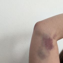 Labcorp - Hematoma/bruising posterior to stick site