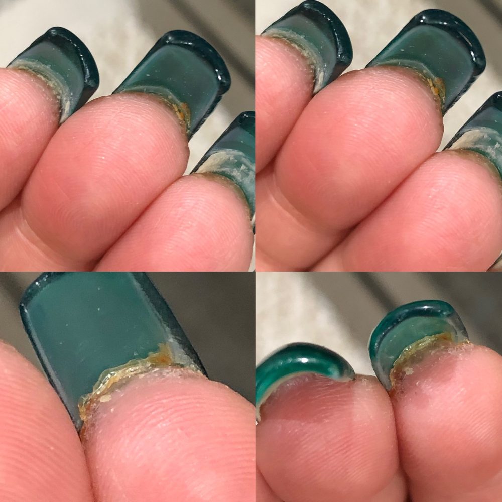 B Nails & Spa - Serious fungal infection - Nail Salons Near Me - North Las Vegas, Nevada B Nails & Spa - Serious fungal infection - Nail Salons Near Me - North Las Vegas, Nevada